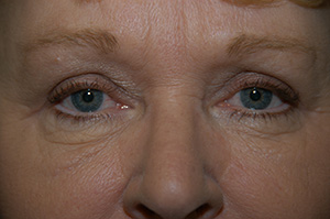 Blepharoplasty 2b